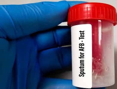 SPUTUM FOR AFB 